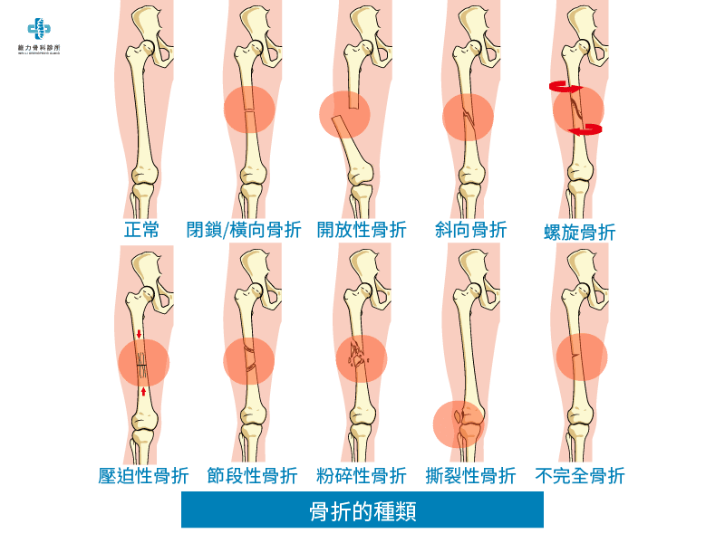 什麼是骨折