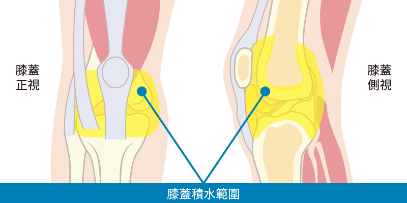 膝蓋積水範圍