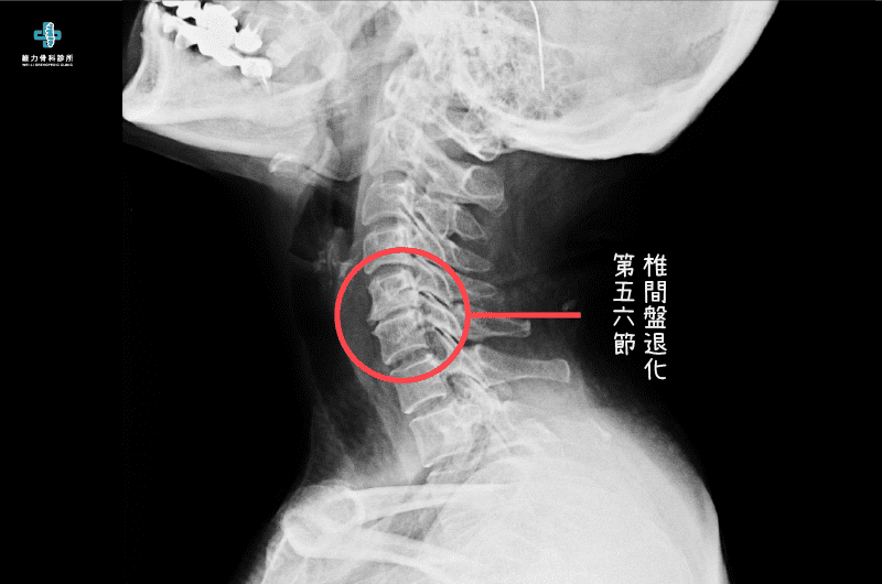 頸椎第五六節椎間盤退化