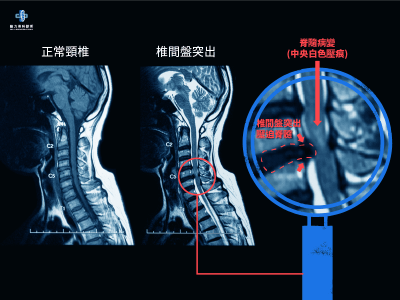 頸椎脊髓病變