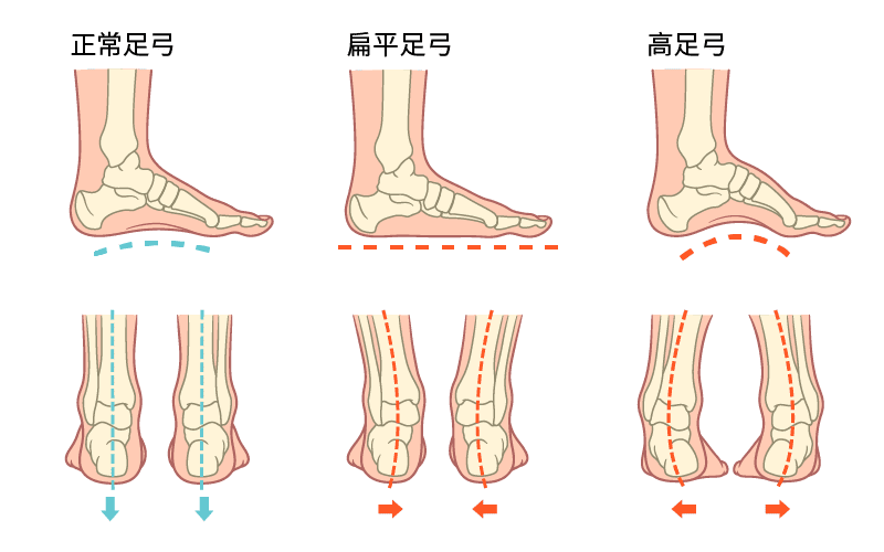 扁平足