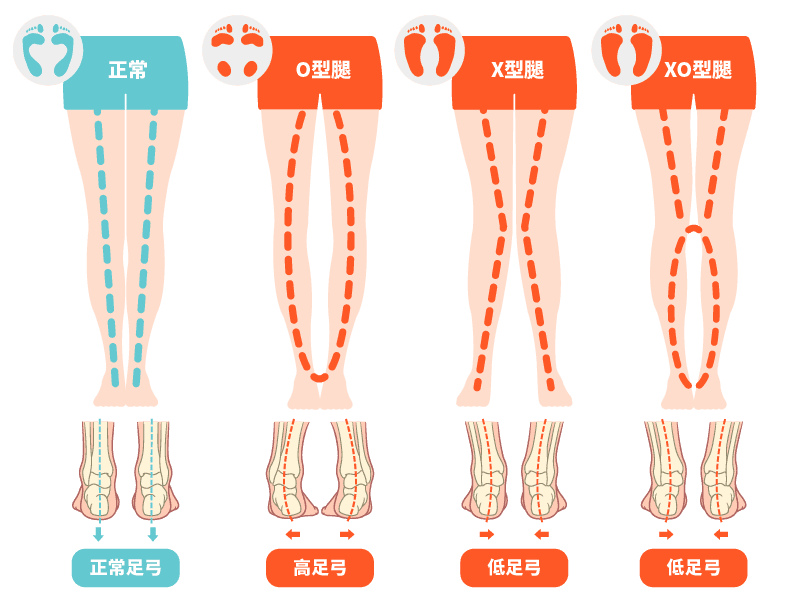 足弓與腿型