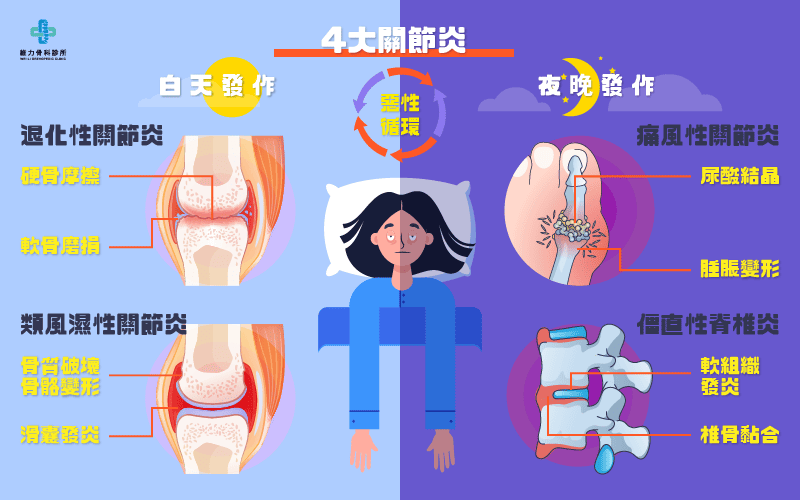 4大關節炎特色