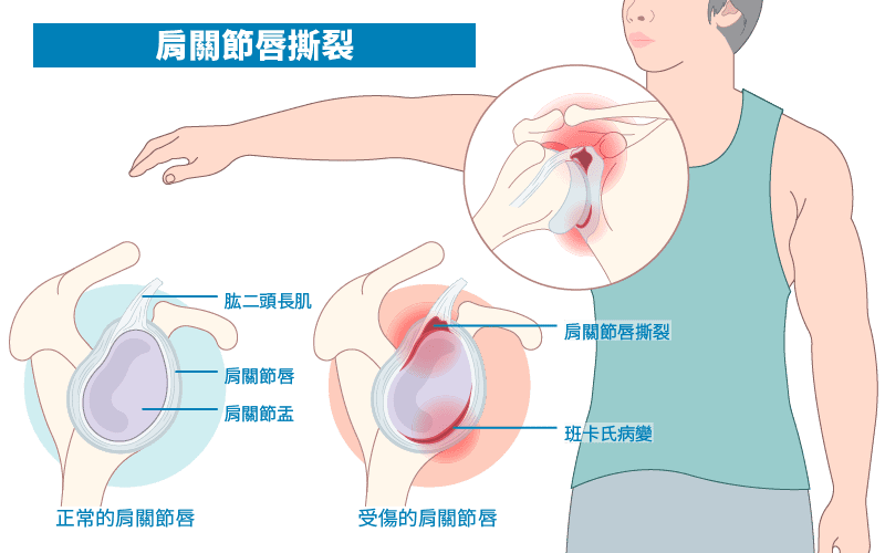 肩關節唇撕裂