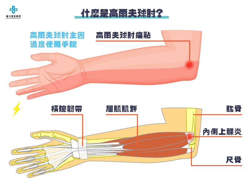 什麼是高爾夫球肘