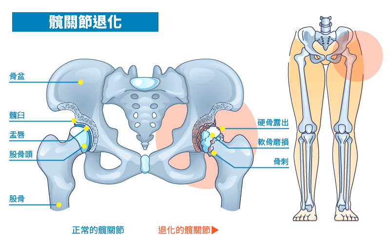 髖關節退化