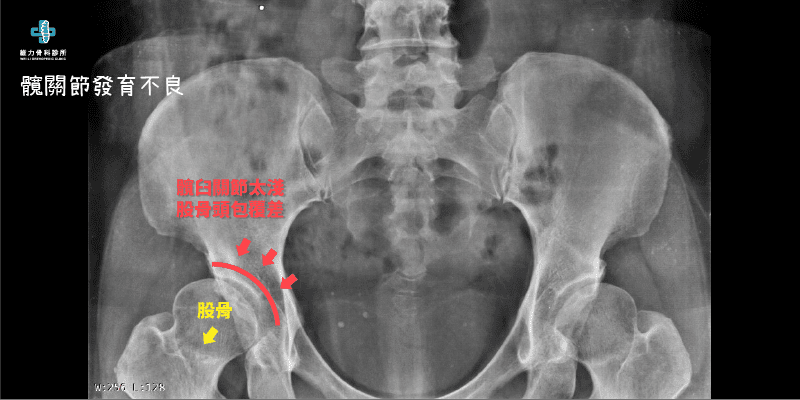 髖關節退化因素