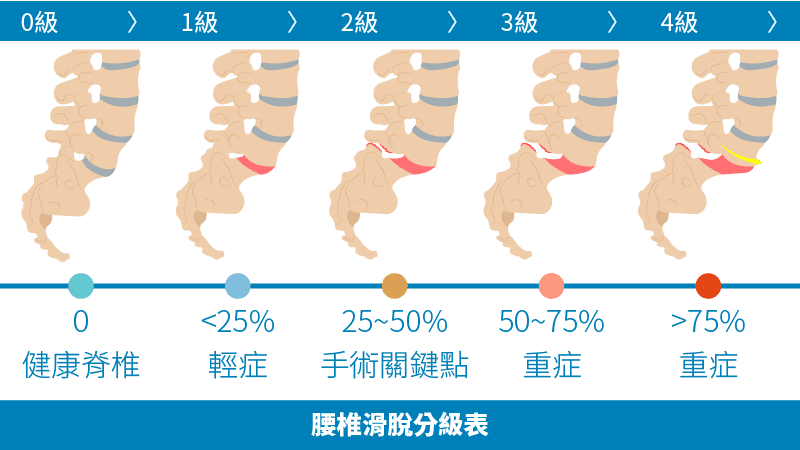 腰椎滑脫分級