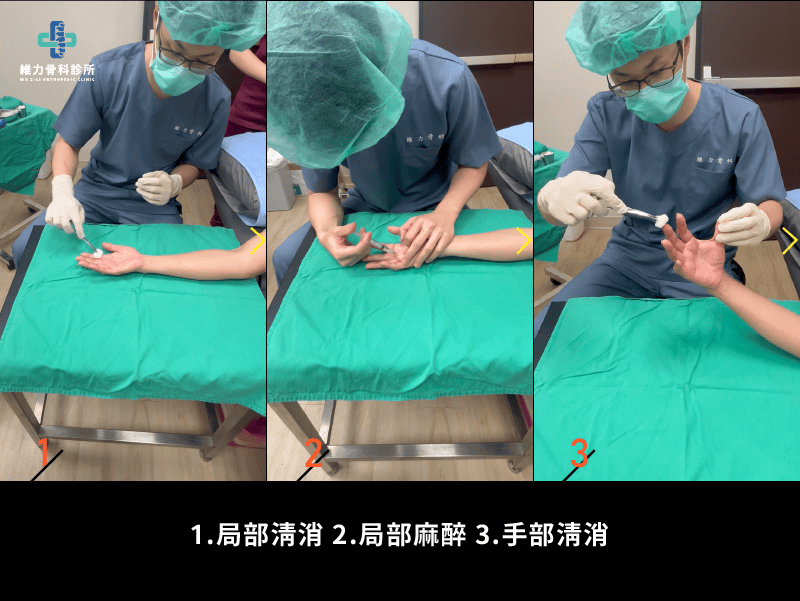 超音波導引板機指微創手術步驟