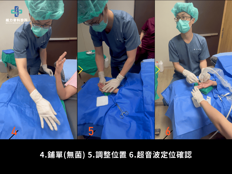 超音波導引板機指微創手術步驟