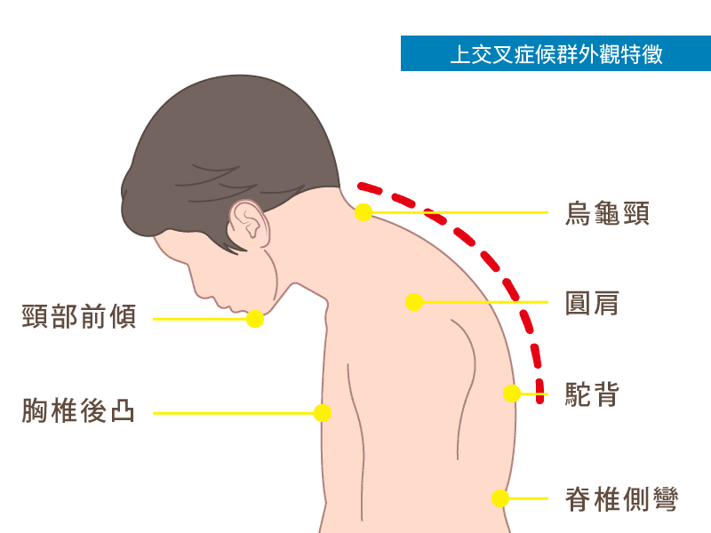 上交叉症候群外觀特徵