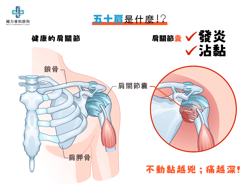 什麼是五十肩
