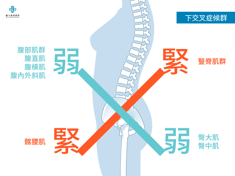 什麼是下交叉症候群