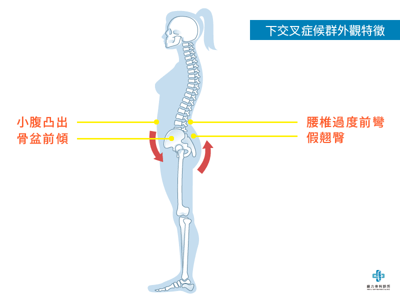 下交叉症候群外觀特徵