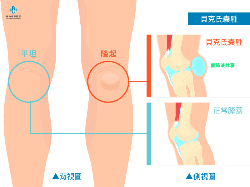 什麼是貝克氏囊腫