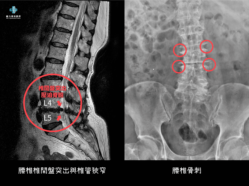 坐骨神經痛的原因