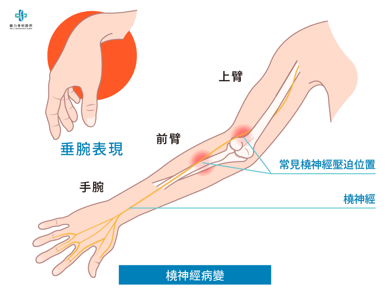 橈神經病變