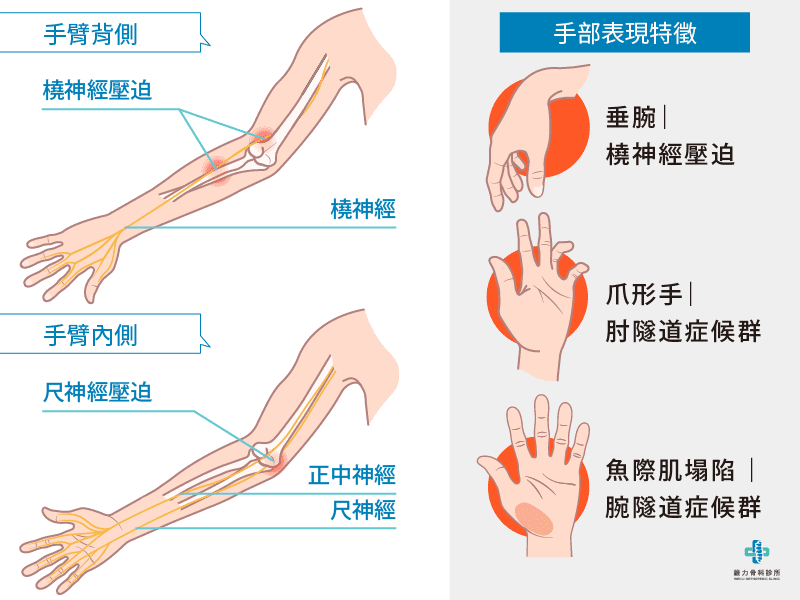 神經壓迫手部表現特徵