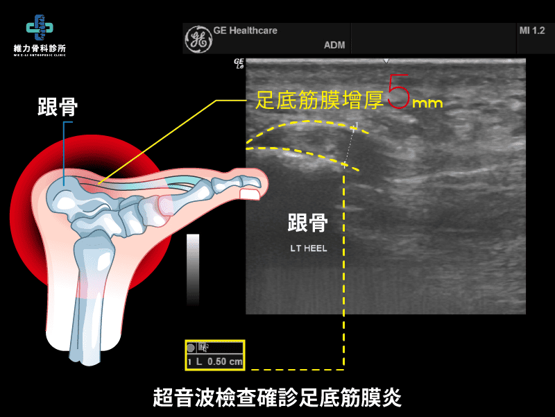 超音波檢查腳底筋膜增厚