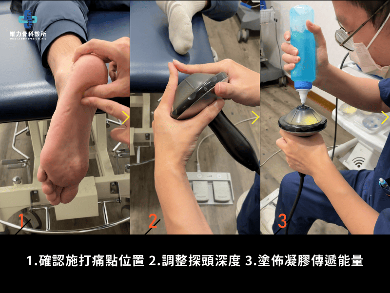 足底震波施打過程