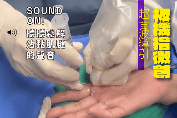 超音波導引微創板機指手術案例