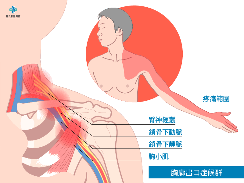 什麼是胸廓出口症候群