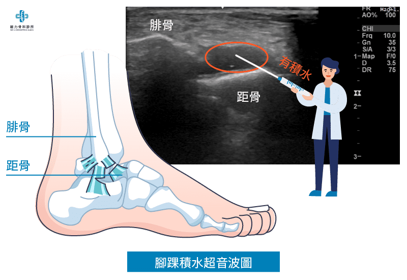 腳踝積水超音波圖