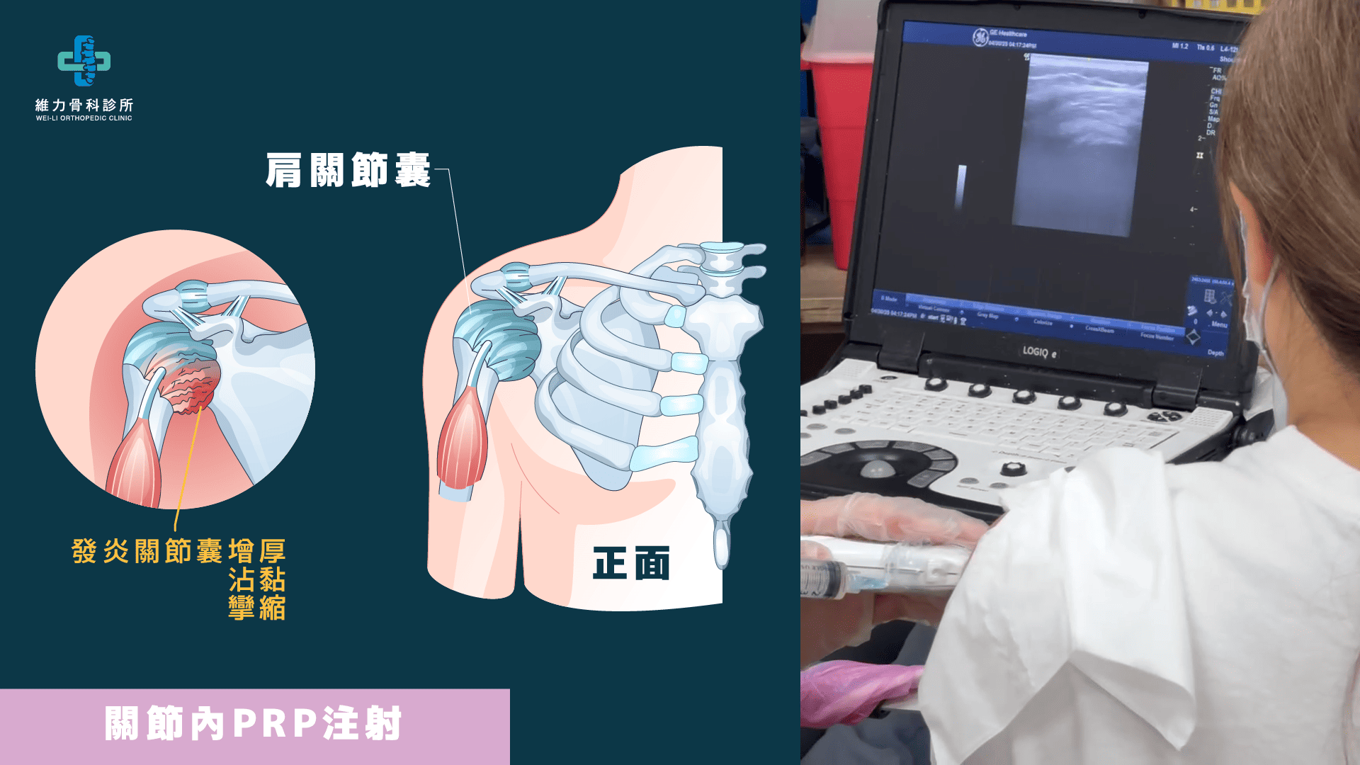 肩關節囊PRP注射