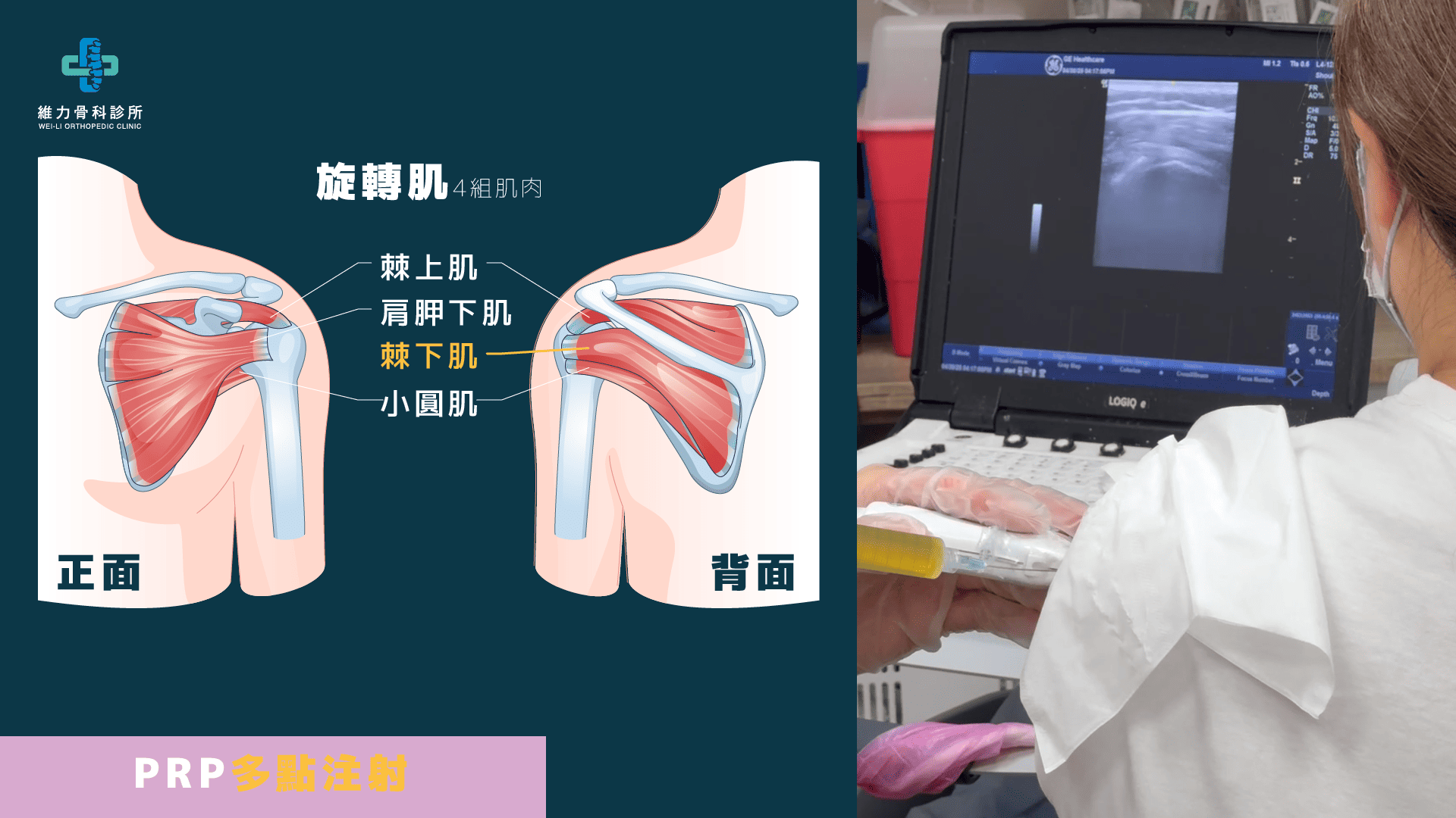 旋轉肌棘下肌PRP多點注射