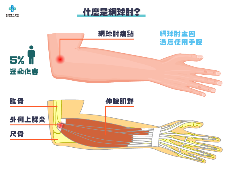 什麼是網球肘