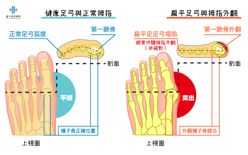 扁平足弓與拇指外翻