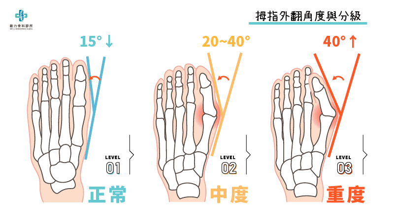 拇指外翻角度與分級