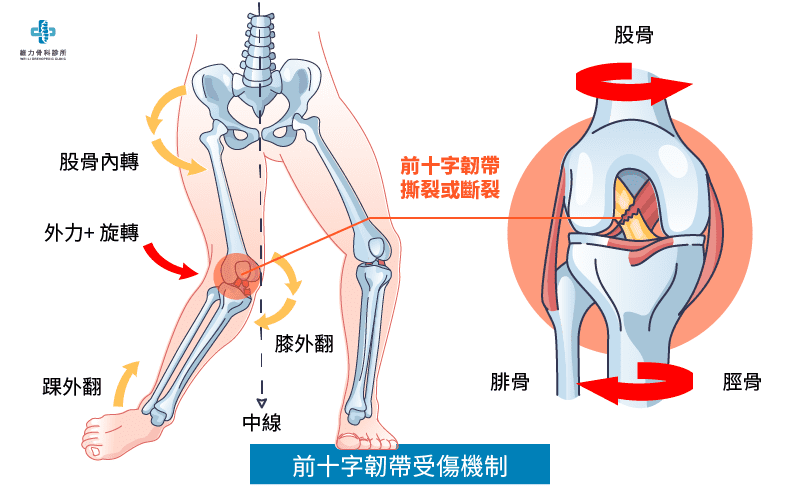 前十字韌帶受傷