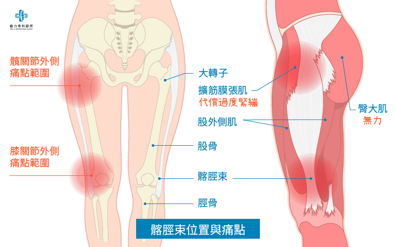 什麼是髂脛束症候群