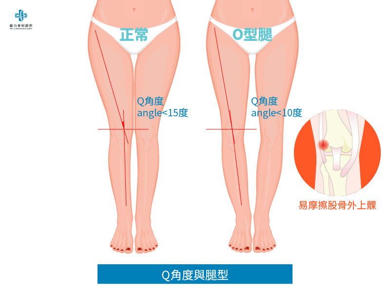 Q角度與腿型