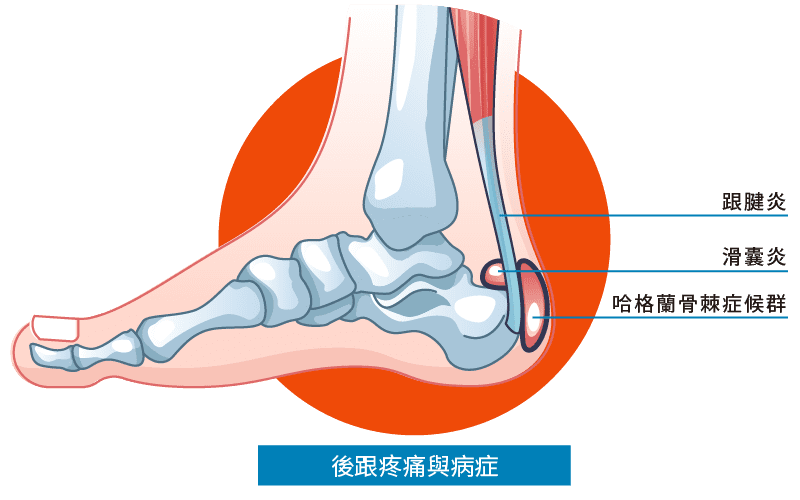 後跟疼痛與病症