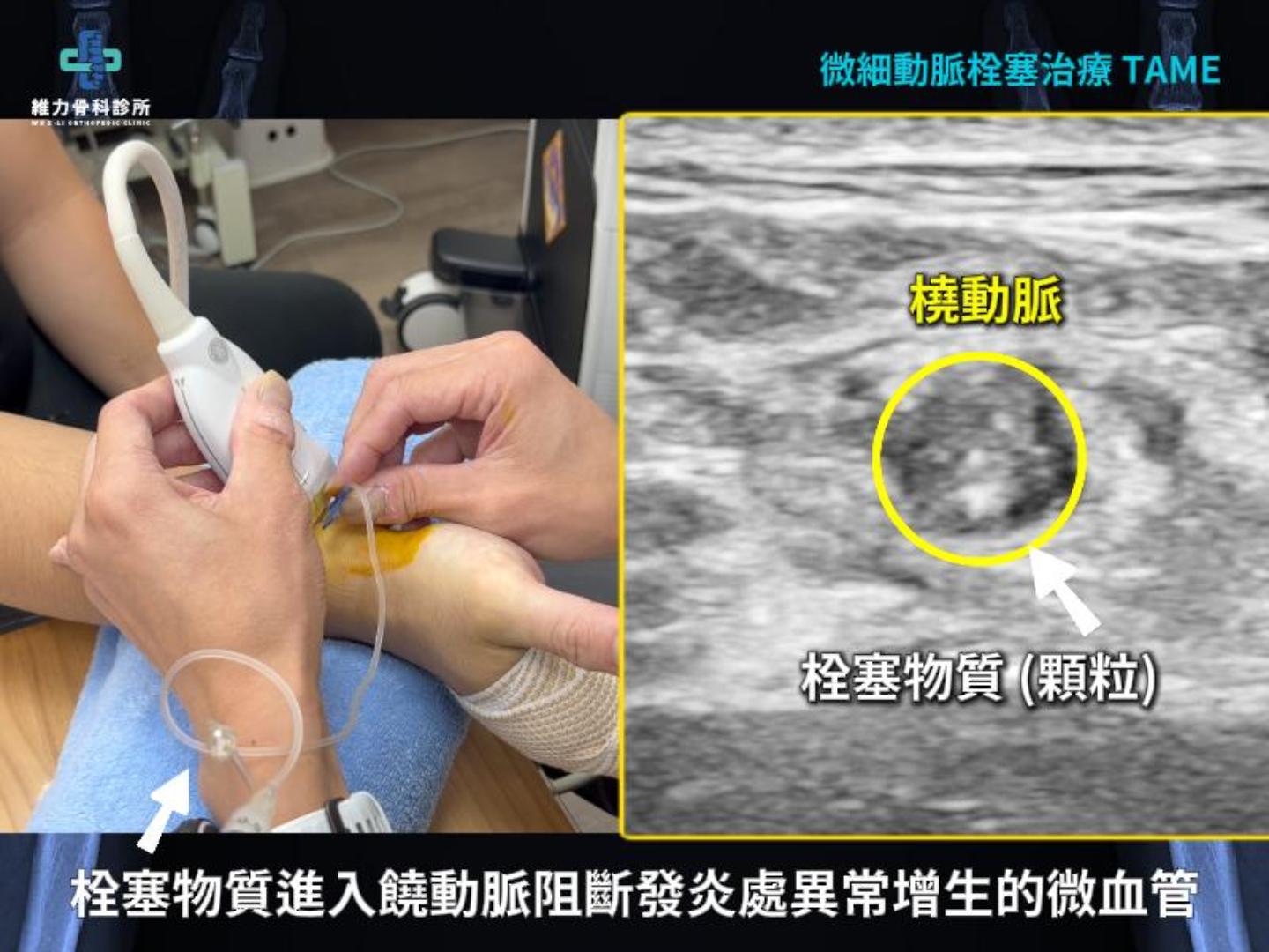 腕掌關節微細動脈栓塞治療