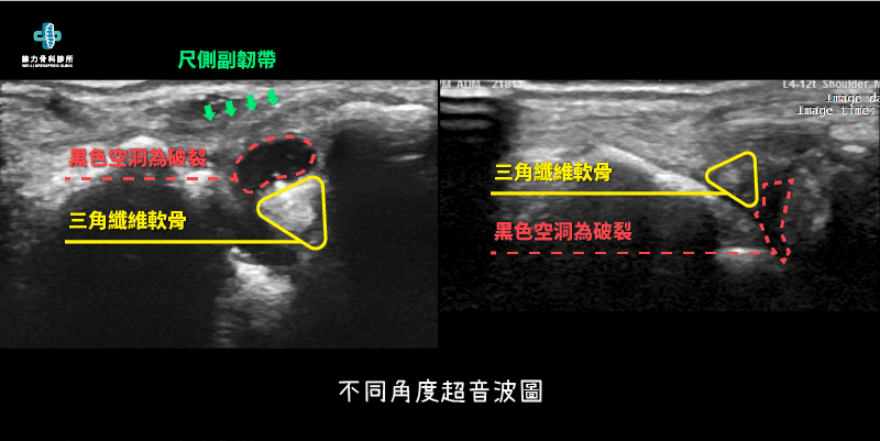 三角纖維軟骨超音波圖