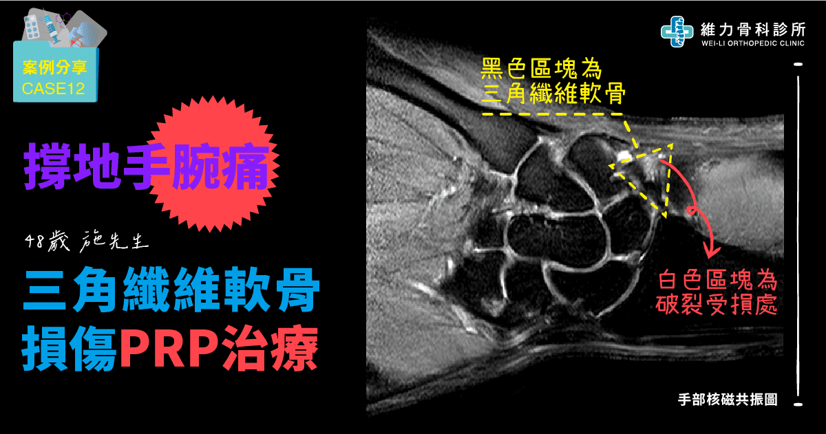 三角纖維軟骨受傷PRP治療