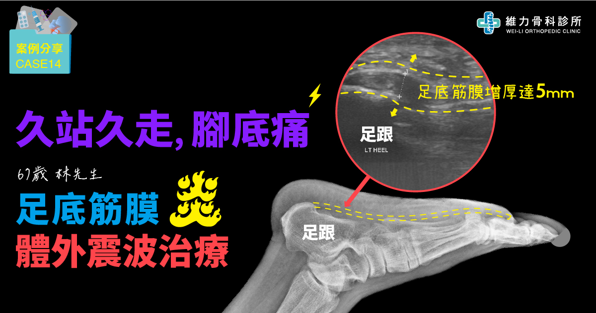 足底筋膜炎