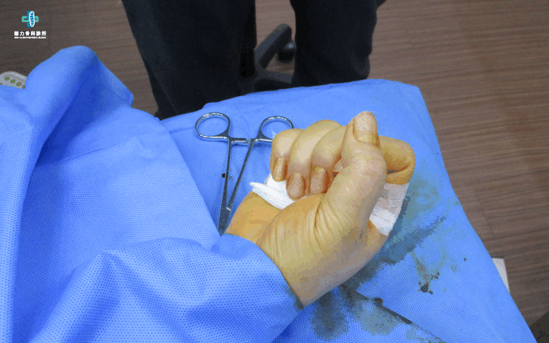 板機指微創手術後手指立即恢復伸縮自如
