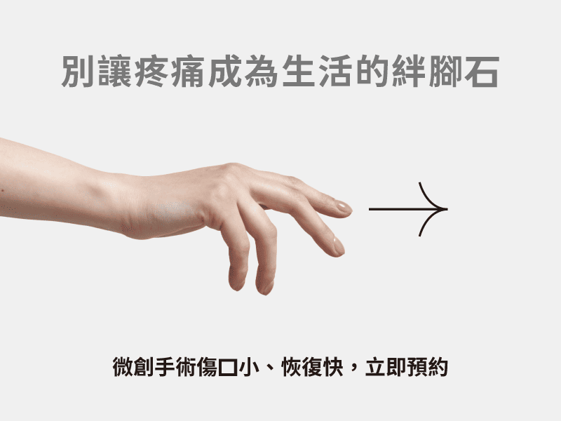 預約板機指微創手術