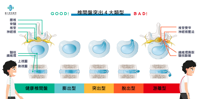 椎間盤突出4大類型