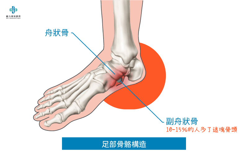 什麼是副舟狀骨症候群