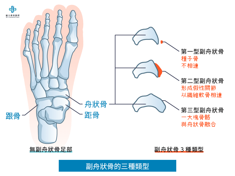 副舟狀骨的三種類型