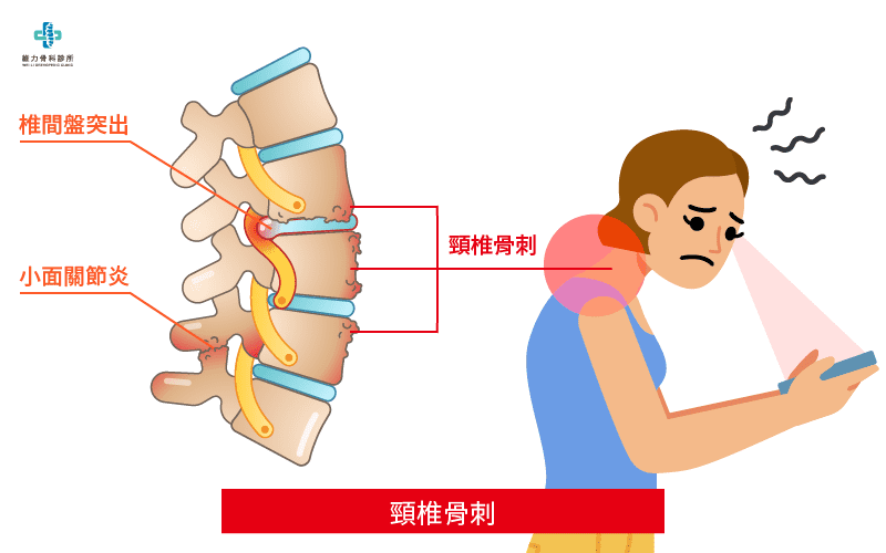 頸椎骨刺