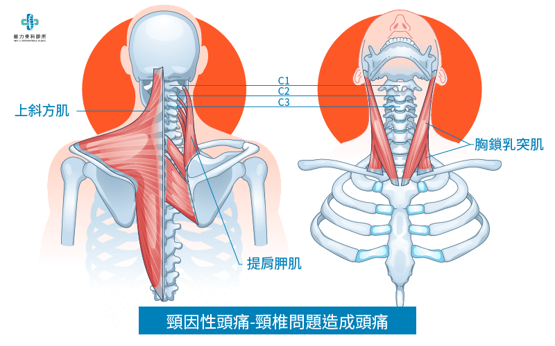 什麼是頸因性頭痛