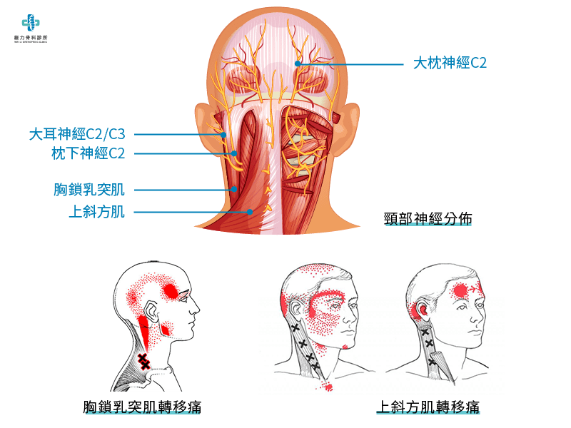 枕神經位置與轉移痛