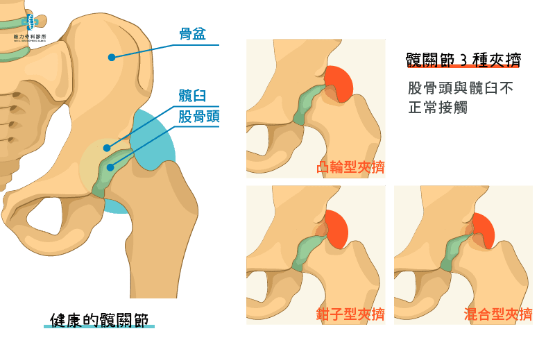 什麼是髖關節夾擠