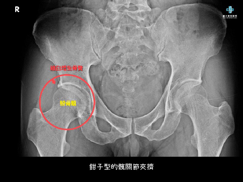 鉗子型髖關節夾擠